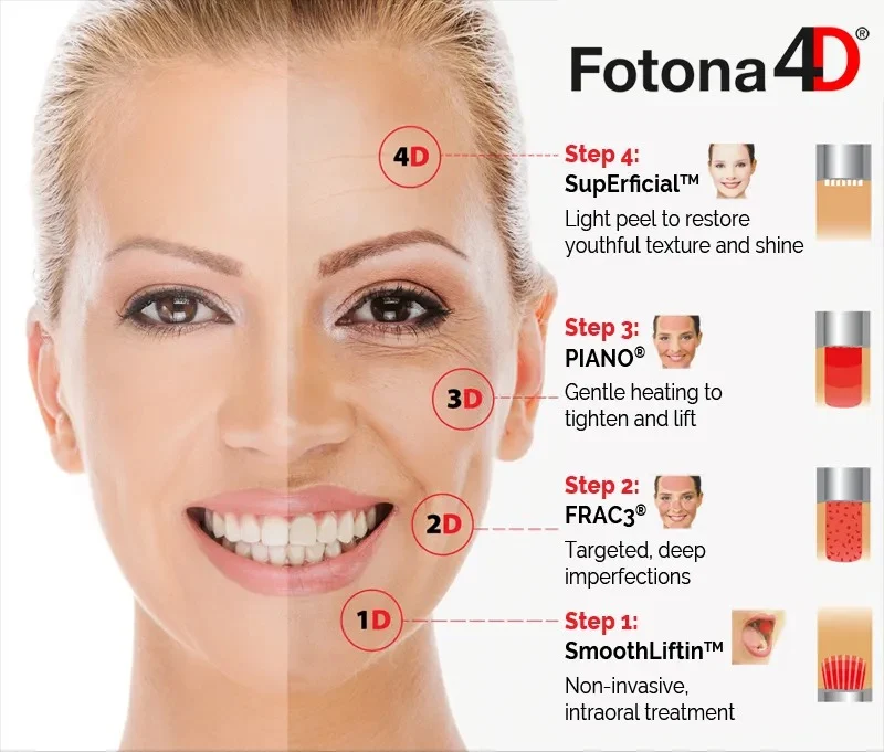 Diagram illustrating the four stages of Fotona 4D laser rejuvenation: SmoothLiftin, FRAC3, PIANO, and SupErficial