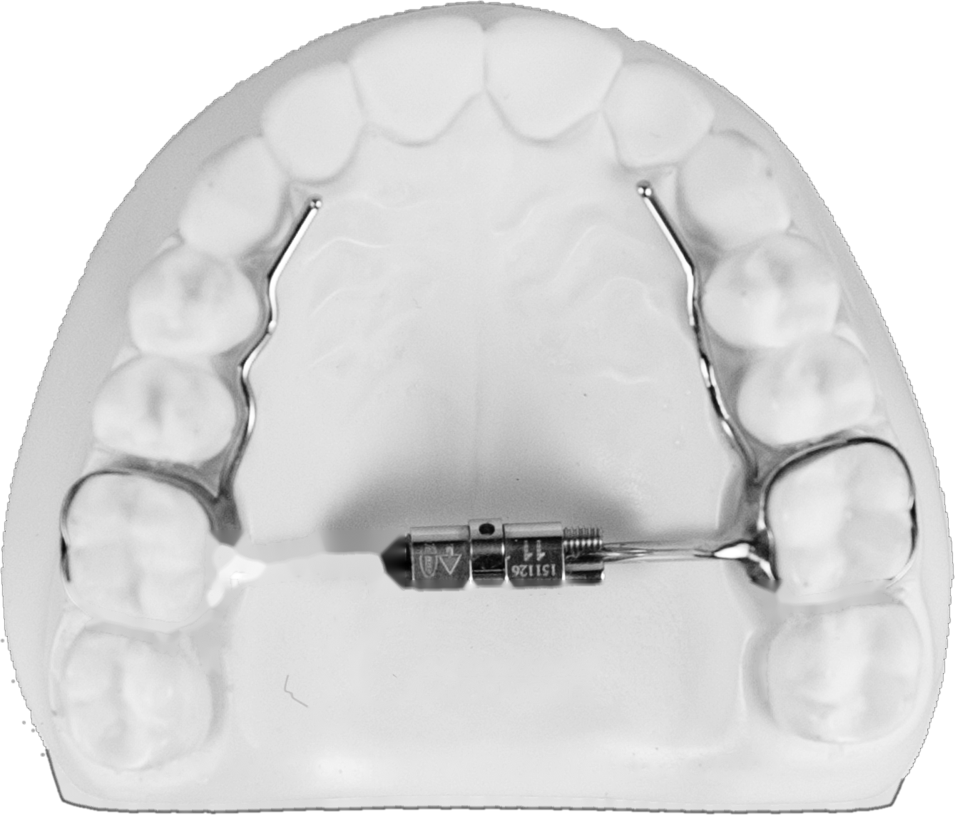 A palatal expander appliance fitted on a model of the upper arch